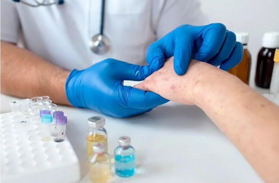 Biorezonans Terapisi ile Böcek Alerjisi Tedavisi